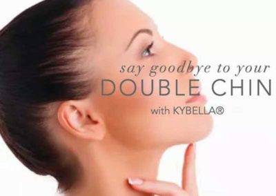 Kybella